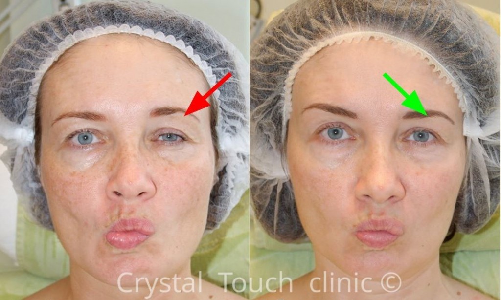 Facial synkinesis