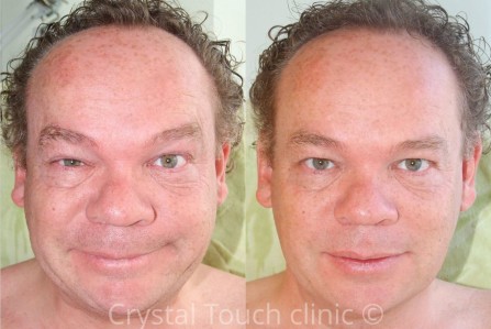 6 лет после неврита лицевого нерва. Результат двух рабочих сессий (Улыбка)