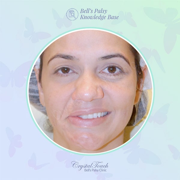 Recovery after acute facial palsy