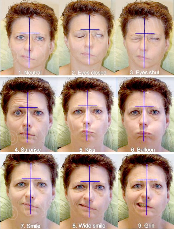 Neurological Tests used to measure recovery progress after Bell's palsy