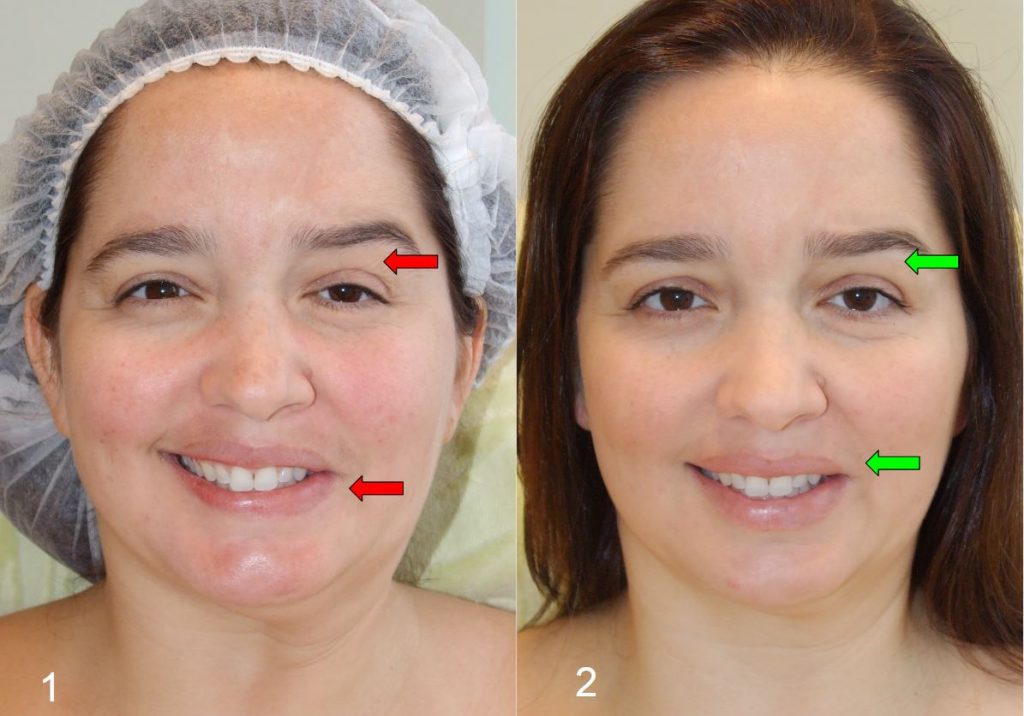 Gabriela - Wide Smile before and after
