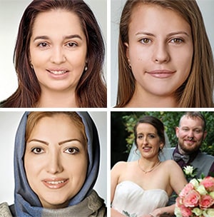 Bell's palsy recovery stories