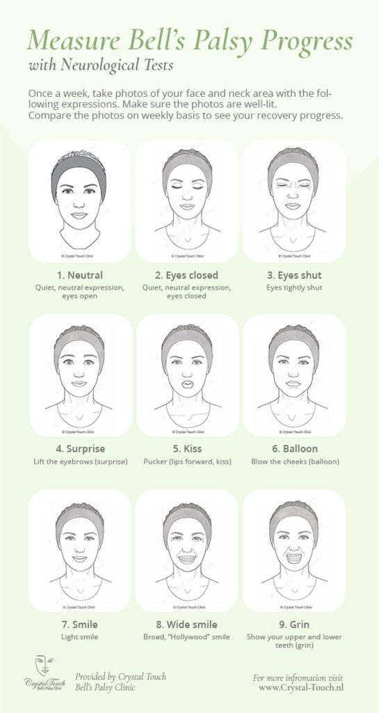 Measuring Bells palsy progress - Neurological Tests