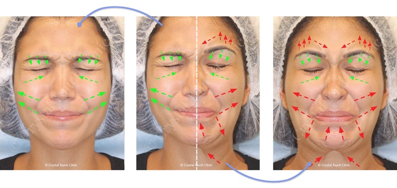 Synkinesis - original (center), mirror healthy side (left), mirrored affected side (right)