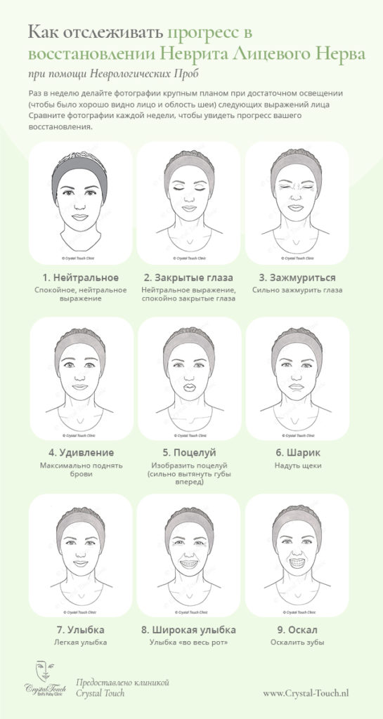 Как отслеживать прогресс в восстановлении после неврита лицевого нерва