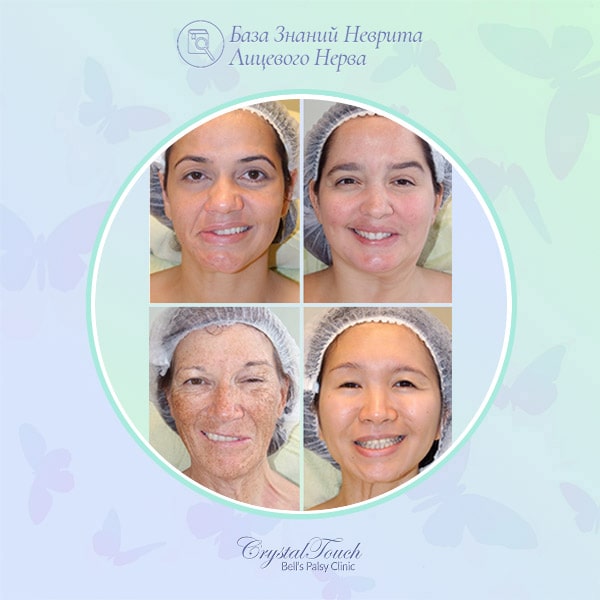 Что такое синкинезии?