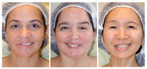 Пациенты с синкинезиями