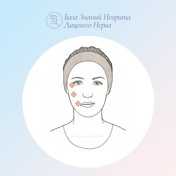 О селективном невролизе, как методе лечения синкинезий