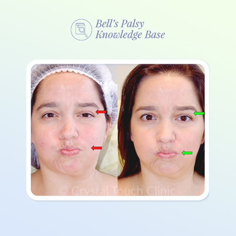 Is it possible to avoid synkinesis?