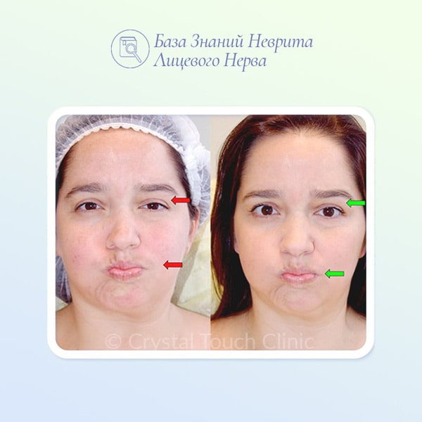 Возможно ли избежать синкинезии