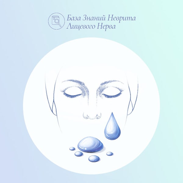 Слезы и сухость глаза при параличе Белла