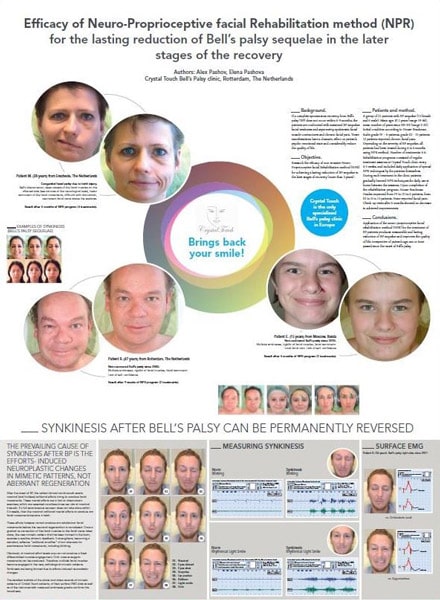 Efficacy of Neuro-Proprioceptive facial Rehabilitation method