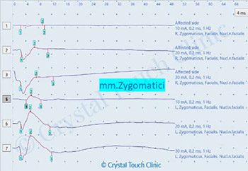 Nerve conduction study, affected side, zygomatic muscles