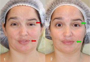 Синдром Рамсея Ханта - удивление