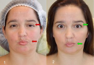 Синдром Рамсея Ханта - поцелуй