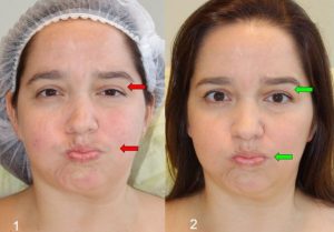 Синдром Рамсея Ханта - шарик