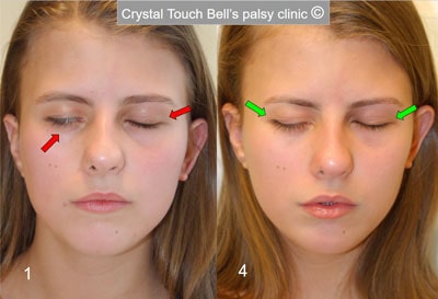 Aline - congenital facial palsy - before and after - eyes closed