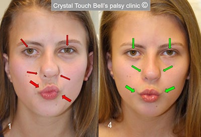 Aline - congenital facial palsy - before and after - pucker