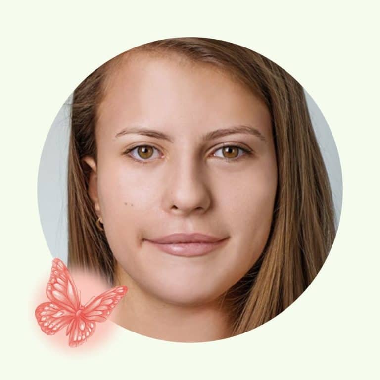 Aline's congenital facial palsy recovery story