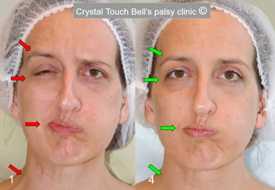 Hannah - Bell's palsy recover story - Before and after balloon