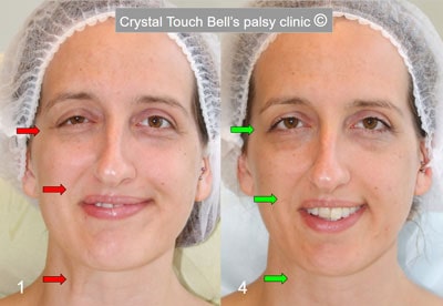 Hannah - Bell's palsy recover story - Before and after smile