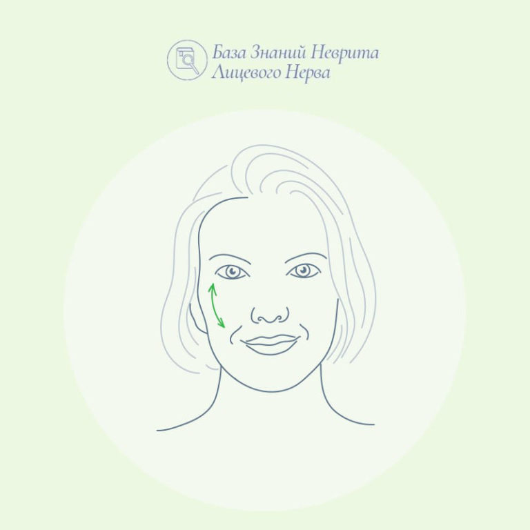 Можно ли исправить синкинезии?