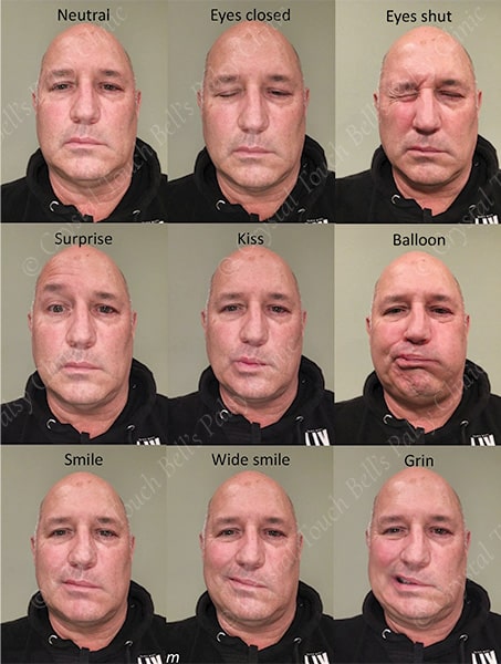 Bell's palsy recovery - Day 1 - Patient J