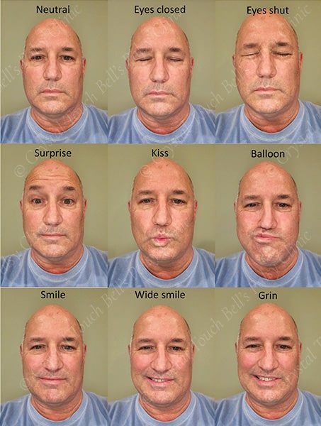Bell's palsy recovery - Day 11 to 15 - Patient J