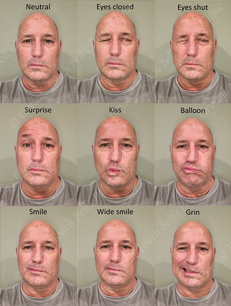 Bell's palsy recovery - Day 2 to 5 - Patient J