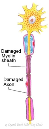 Extensive damage to the facial nerve