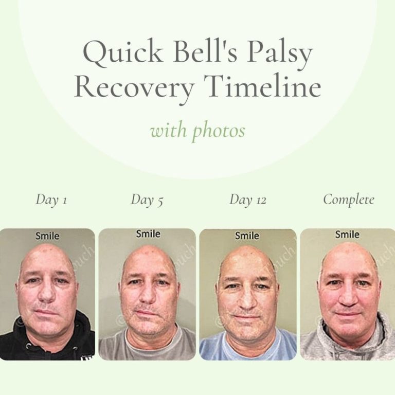 Quick Bell's Palsy recovery timeline (with photos)
