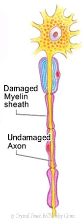 Superficial damage to the facial nerve