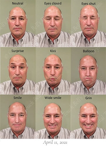 Bells palsy recovery April 11 small