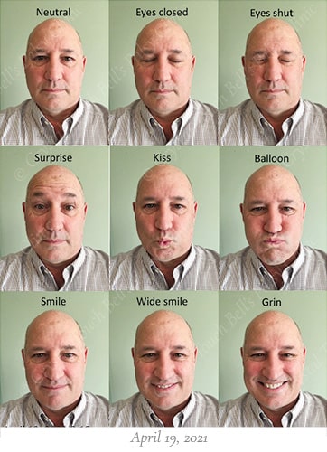 Bells palsy recovery April 19 small