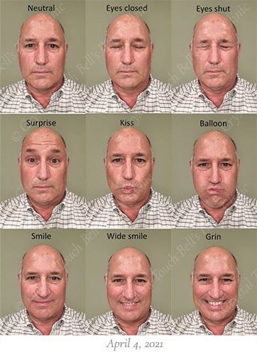 Bells palsy recovery April 4 small