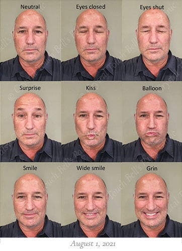 Bells palsy recovery Aug 1 small