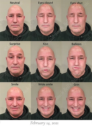 Bells palsy recovery Feb 14 small