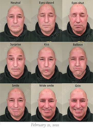 Bells palsy recovery Feb 21 small