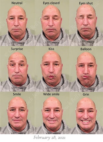 Bells palsy recovery Feb 28 small