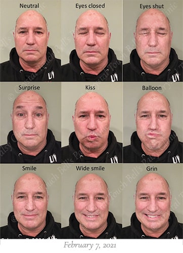 Bells palsy recovery Feb 7 small