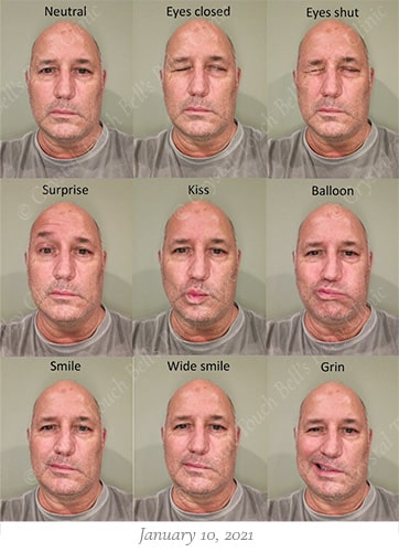Bells palsy recovery Jan 10 small