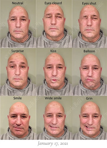 Bells palsy recovery Jan 17 small