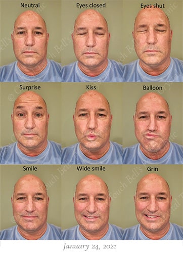 Bells palsy recovery Jan 24 small