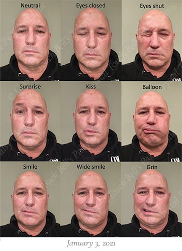 Bells palsy recovery Jan 3 small