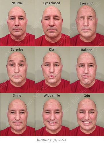 Bells palsy recovery Jan 31 small