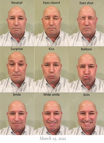 Bells palsy recovery March 15 small