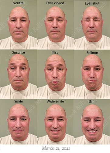Bells palsy recovery March 21 small