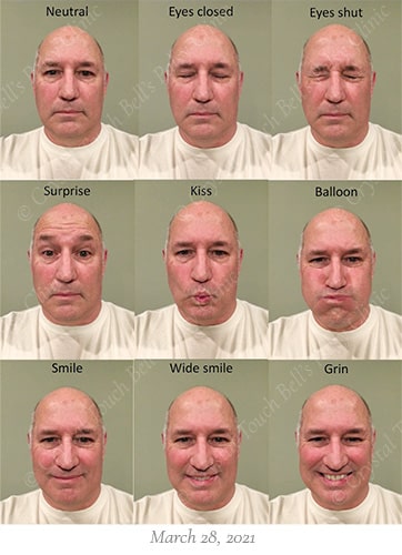 Bells palsy recovery March 28 small