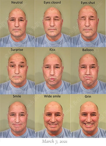 Bells palsy recovery March 7 small