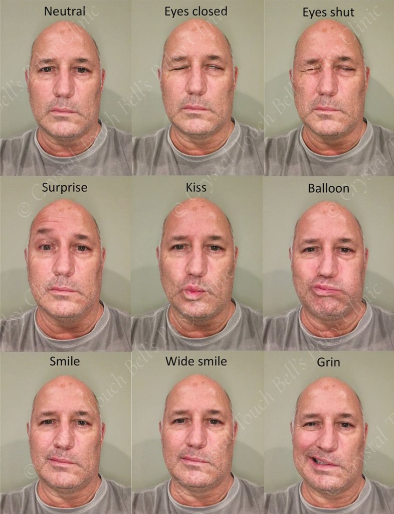 Examples of Neurological Tests
